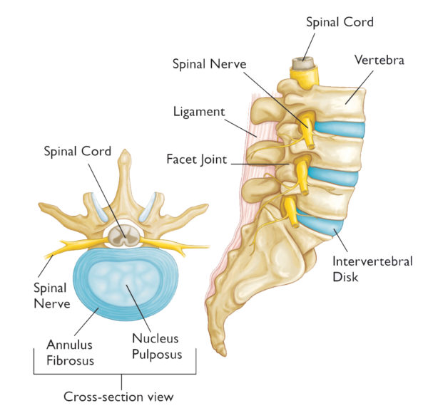 Understanding Herniated Disc Robert S Bray, Jr MD